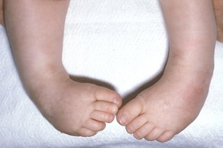 Close-up of the feet of a baby with club foot. Both feet are turned inwards so that the toes of each foot are touching.