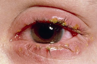 A sore, red eye with conjunctivitis. There's yellowish discharge on the lash line.