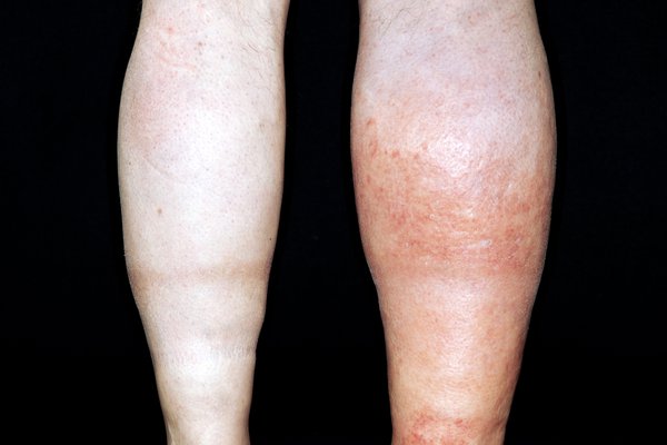 Swollen and red right leg caused by DVT (deep vein thrombosis), shown on white skin.