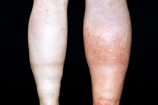 Swollen and red right leg caused by DVT (deep vein thrombosis), shown on white skin.