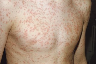 A rash of hundreds of small pink spots covering the chest of a child with pale skin.