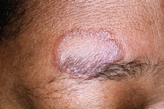 Sarcoidosis shown on light brown skin. There is an oval shape bump on someone’s forehead, slightly purple at the edges.