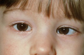 Close-up of a a child’s eyes and nose. Their left eye is turning in (a squint) and their right eye is looking ahead.