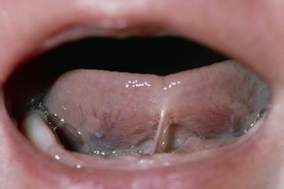 Close-up of a baby's open mouth with their tongue pulled back. There's a short strip of skin connecting the tongue to the bottom of the mouth.