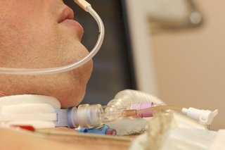 A close-up of a person with a tracheostomy tube connected to his throat