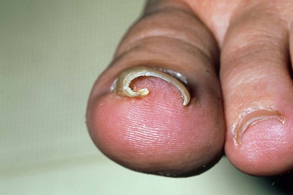 When Should You Go to the Doctor for an Ingrown Toenail? - MVS