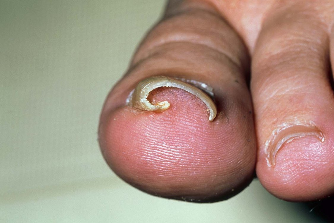 Ingrown toenail NHS