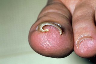 ingrown toenail healing