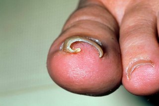 A ingrown toenail in the big toe seen from the front, showing the toenail curving into the toe.