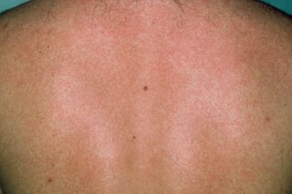 The rubella rash in someone with light brown skin. There are faint, red blotchy patches covering most of the skin.