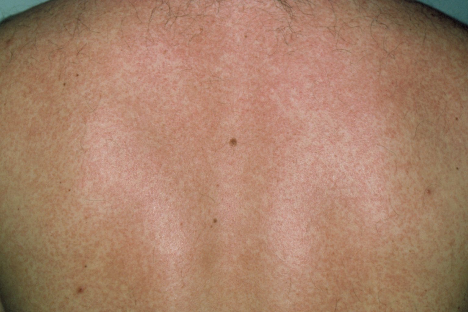 salicylic acid for pinpoint red dots on skin