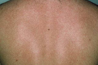 The rubella rash in someone with light brown skin. There are faint, red blotchy patches covering most of the skin.