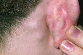 2 small lumps under the skin behind someone's right ear.
