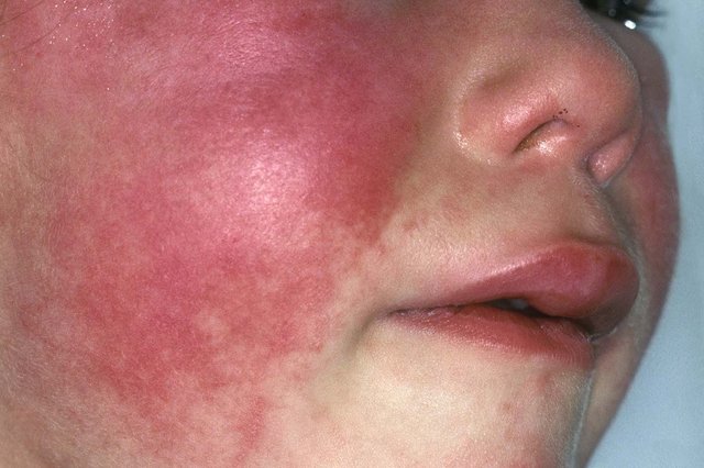 Scarlet Fever NHS