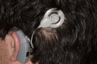 A round, plastic auditory brainstem implant device attached just above and behind the ear, connected to a microphone worn behind the ear.