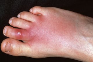 Foot with a red swollen spot on the second toe with redness spreading out across the top of the foot. Shown on white skin.