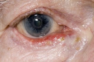 Close-up of a person's eye with a red, sore-looking lower eyelid that's turned outwards.
