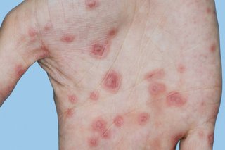 Erythema multiforme on white skin. There are over 20 red, round spots on a hand. Some spots have pink rings around them.