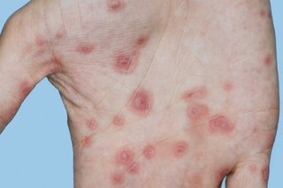 Erythema multiforme on white skin. There are over 20 red, round spots on a hand. Some spots have pink rings around them.