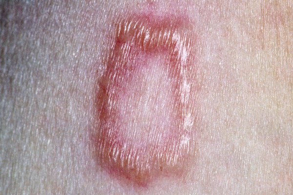 14 Common Bug Bites - Identifying Insect Bites Pictures