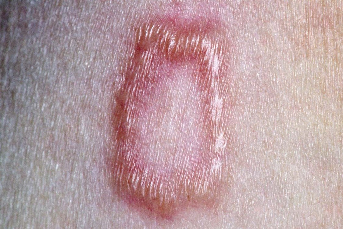 Granuloma annulare - NHS