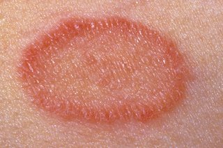 Close-up of a herald patch on white skin. The patch is oval-shaped, scaly and pink, with a darker pink border.