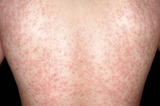 Widespread rash on the back of a person with white skin. There are many small, pink spots that are close together.