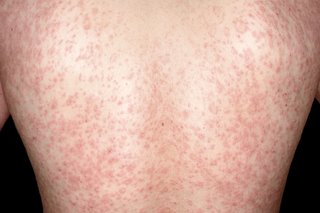 Picture of widespread red, scaly rash on the back of a person with white skin.