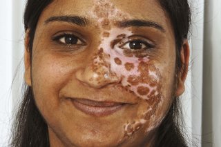 Picture of a woman with segmental vitiligo affecting the face