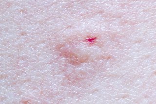 Spider bites: Identification and treatment