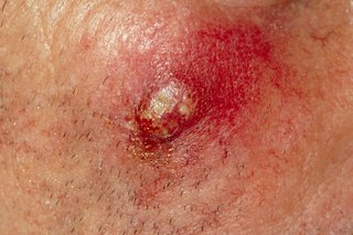 A boil on white skin leaking pus. The lump is raised, with yellow pus at the centre. The surrounding skin is red and bleeding.
