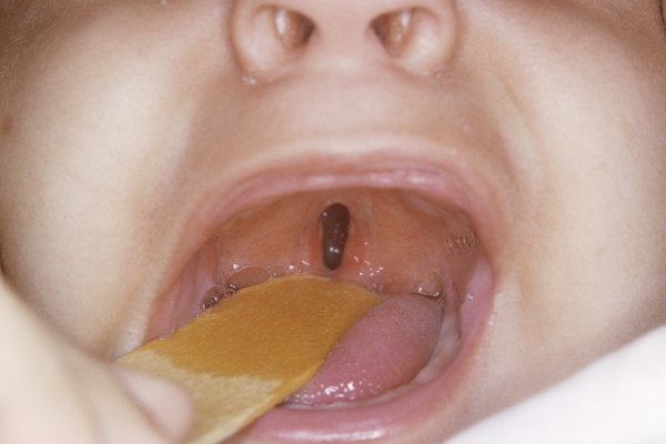 The inside of a baby's open mouth showing a narrow hole in the palate at the back of the throat