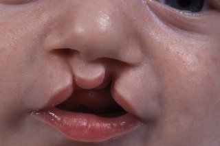 Cleft lip on a baby where the baby’s top lip has not formed properly and there are 2 gaps between the top lip and the nostrils