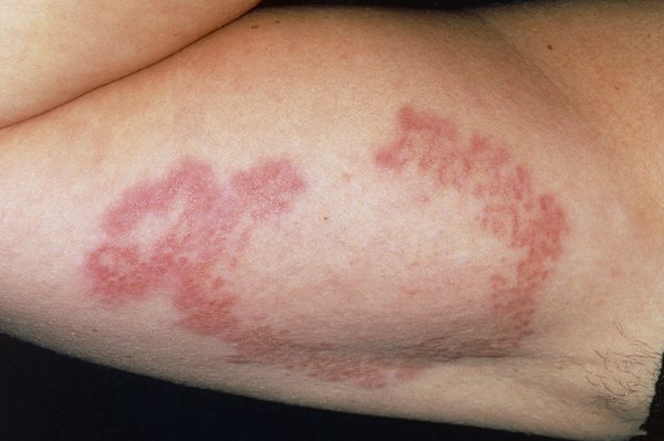 Skin rashes in children | NHS inform