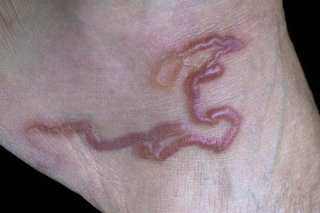 A large, dark pink hookworm underneath a person's skin.