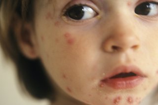 What causes red bumps on toddlers face