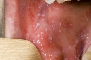 A number of very small white spots inside a person’s mouth.