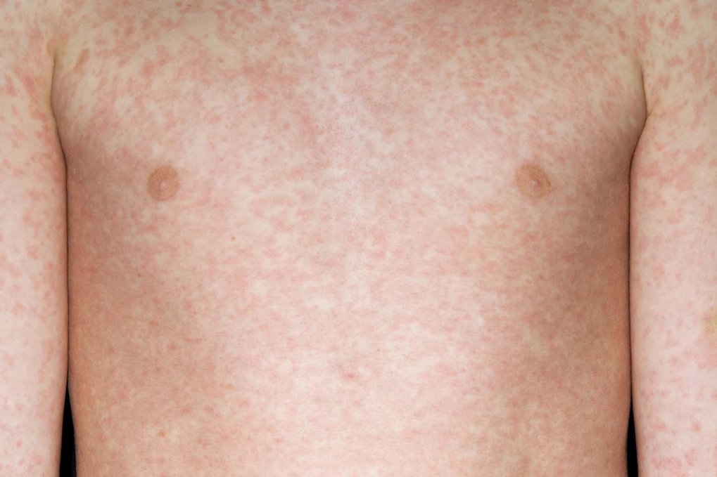 Rashes In Babies And Children NHS