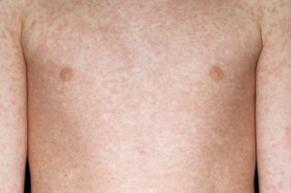 The measles rash on a person with white skin. The person’s arms, chest and tummy are almost completely covered with red, blotchy patches.