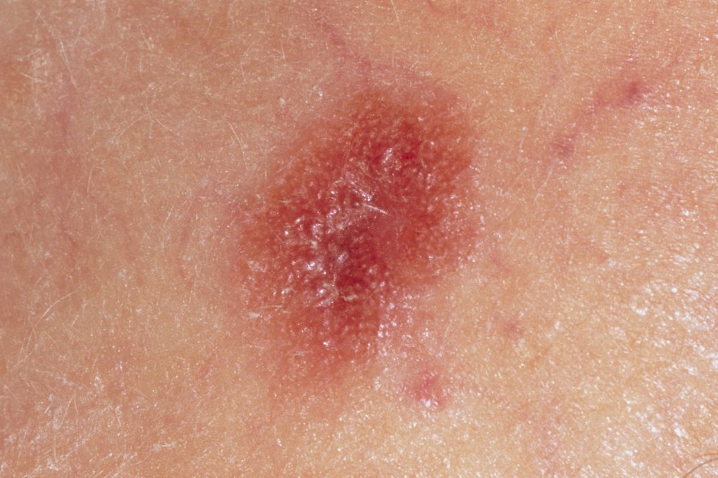 melanoma-skin-cancer-nhs