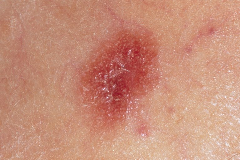 Melanoma skin cancer - NHS