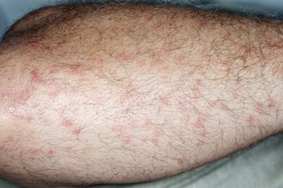 A group of small raised, red midge bites, shown on white skin.