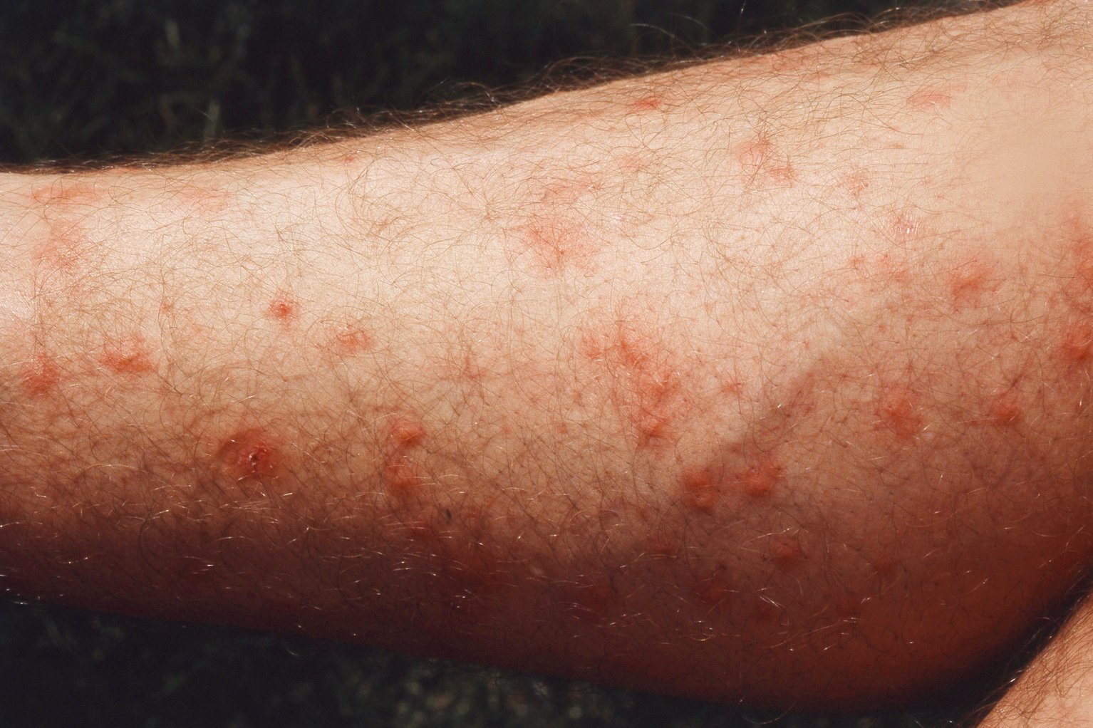 do flea bites itch on humans