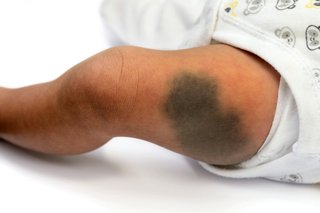 Large, dark blue-grey patch that looks like a bruise on a baby's thigh