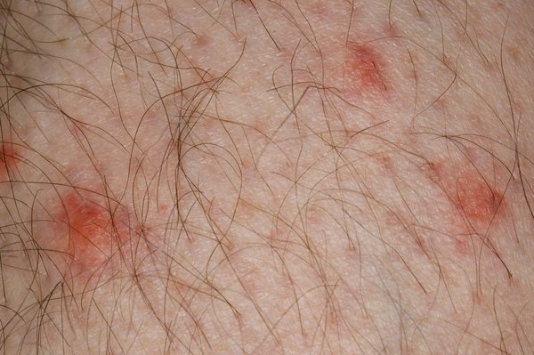 Mosquito bites