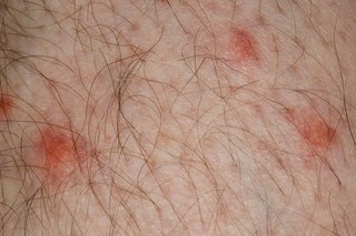 Close-up image of 4 red, slightly raised spots from mosquito bites. Shown on white skin.