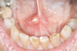 The inside of a person's mouth showing their lower teeth and part of their bottom lip. There is a small, white salivary gland stone under their tongue.
