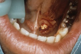 A close-up of the inside of a person's mouth with a large white salivary stone under their tongue