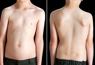 A front and back image of the body of a young white adult male affected by scoliosis, showing a noticeable curve of the spine