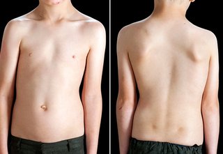 Scoliosis Rib Hump Results - Scoliosis Care Centers